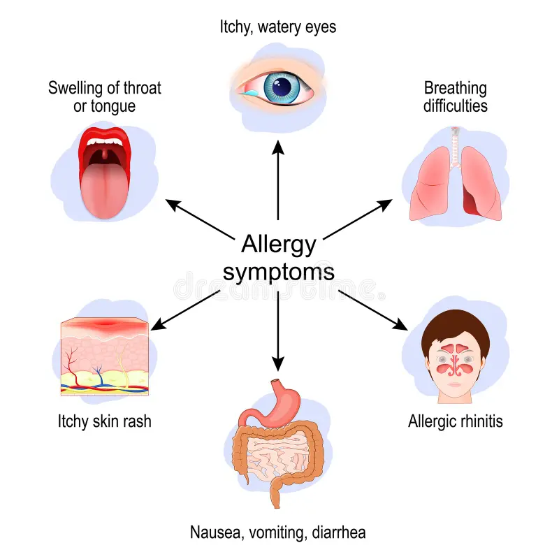 allergy symptoms allergic rhinitis breathing difficulties swelling throat tongue nausea itchy skin rash vector 413152962 (1)